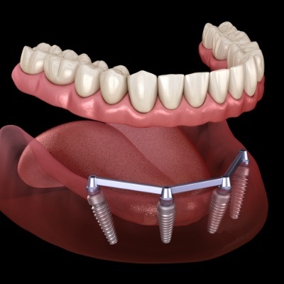 Animated smile showing how all on four dental implants work