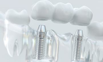 a 3 D illustration of a traditional dental bridge