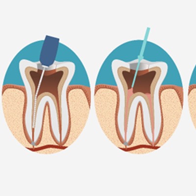 illustration of root canal treatment in Chesapeake