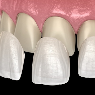 Animated smile during veneer placement