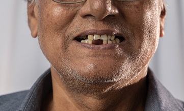 Man with missing teeth