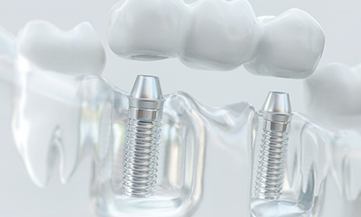 Model of implant bridge