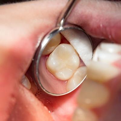 Dental mirror showing tooth-colored filling in patient’s mouth