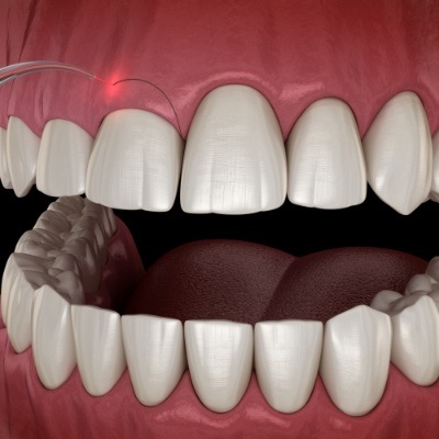 Animated smile during gum recontouring process
