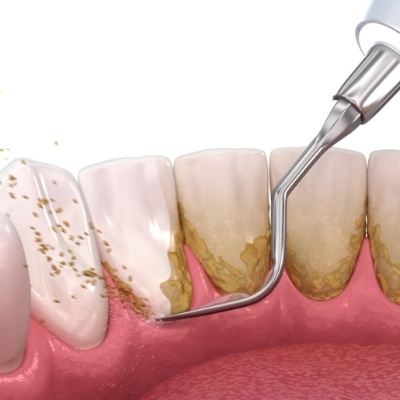 Animated smile during scaling and root planing treatment