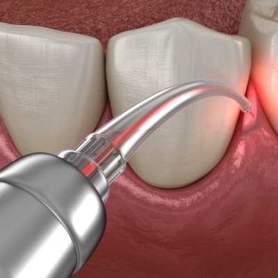 Animated smile during laser periodontal treatment