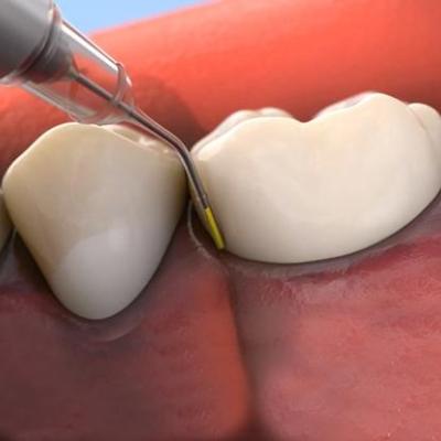 Animated smile during antibiotic therapy