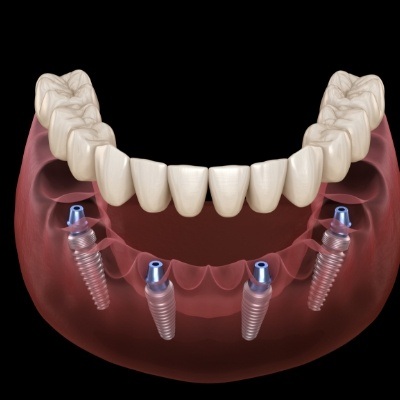 Animated smile during implant denture placement