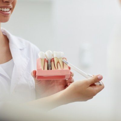Dentist holding up a model showing dental implant supported tooth replacement