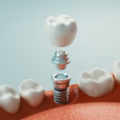 Animated smile during dental implant replacement tooth placement