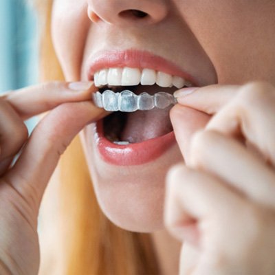 Woman putting in aligner for Invisalign in Chesapeake Virginia