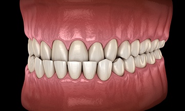 Illustration of an underbite