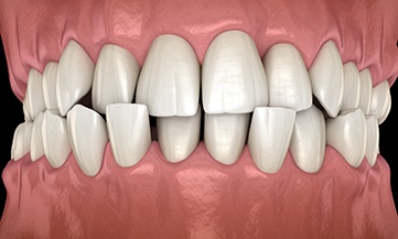 Illustration of a crossbite