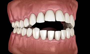 Illustration of an open bite