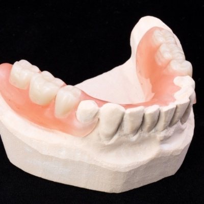 Model smile with partial denture