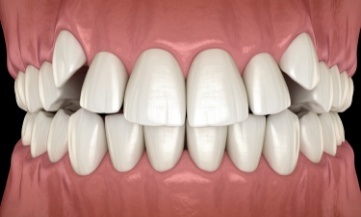 Smile with corded teeth before Invisalign orthodontic treatment