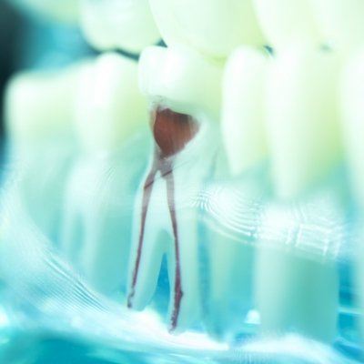 Model smile with root canal treated tooth