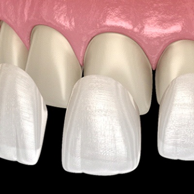 3D illustration of veneers in Chesapeake