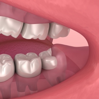 Animated smile with impacted wisdom tooth prior to extraction