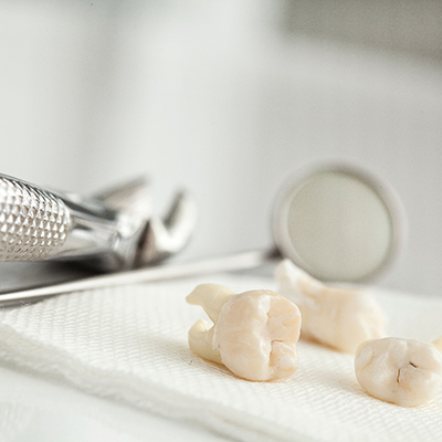 example of wisdom tooth extractions in Chesapeake