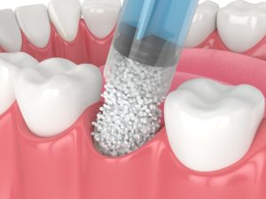 3D render of dental bone grafting with biomaterial application