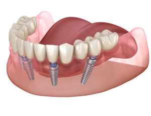 3D image of All-on-4 dental implants 