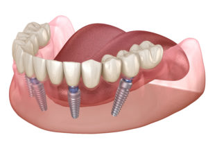 3D image of All-on-4 dental implants