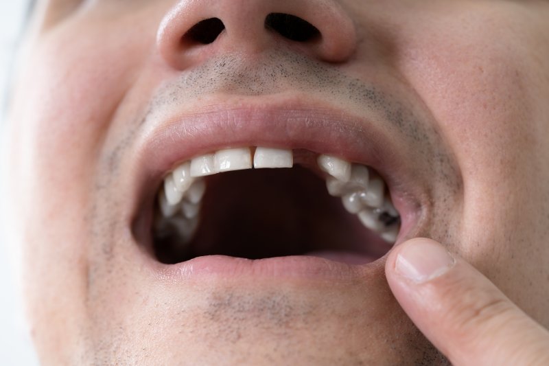 A closeup of a mouth with a missing tooth