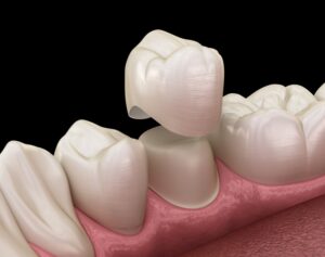 Animated model of dental crown.