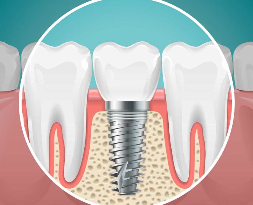 Cartoon cross section of a dental implant