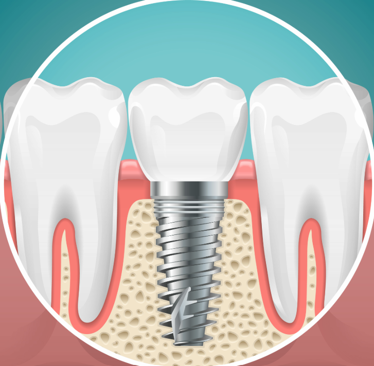 Illustrated cross section of a dental implant