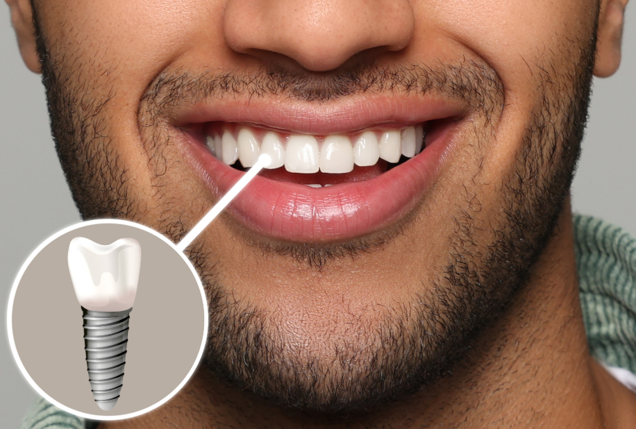 Close up of man's mouth showing dental implant