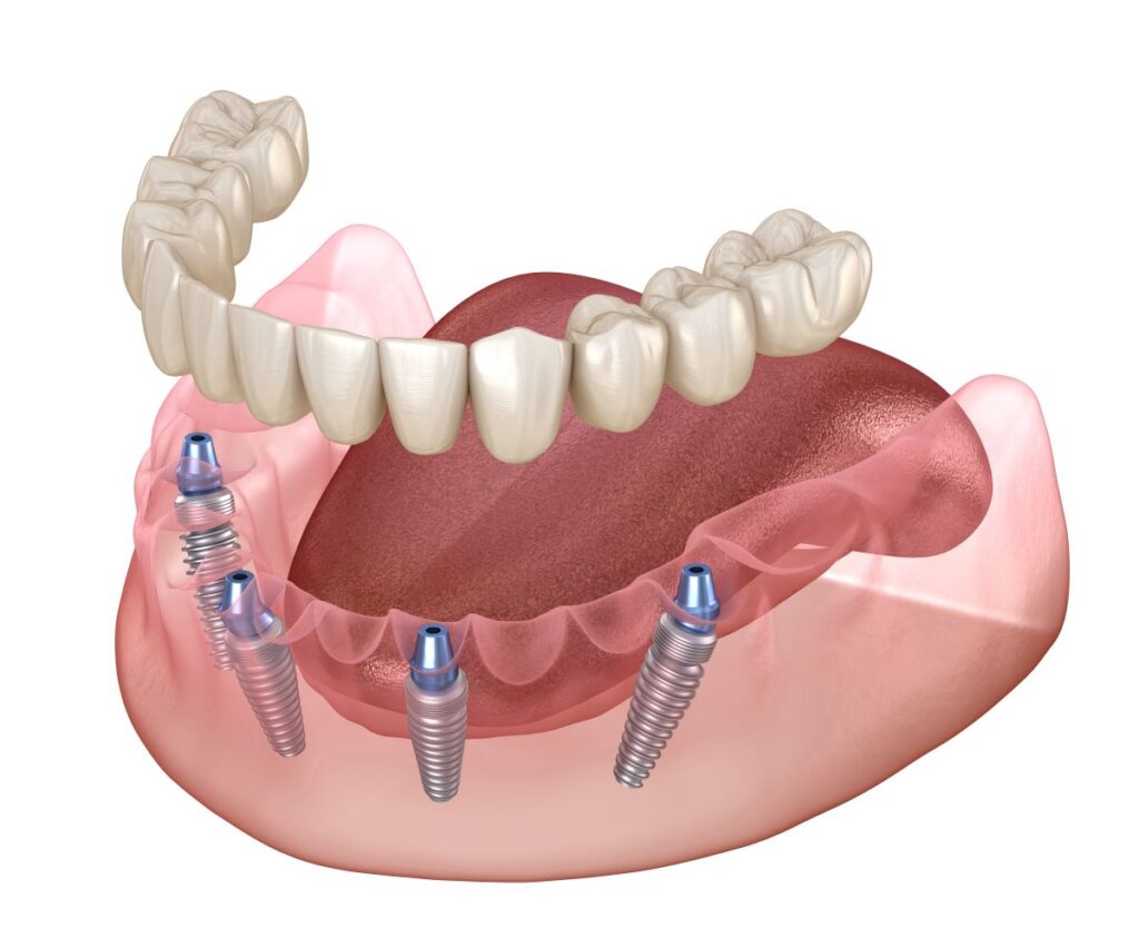 A CGI of All-on-4 being implanted in a jaw